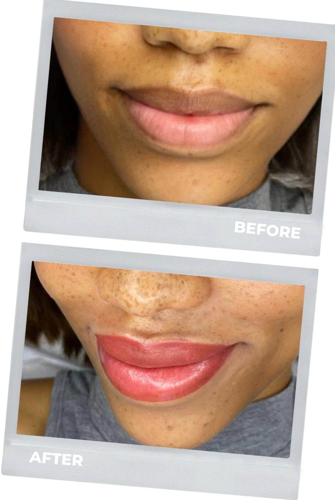 lip neutralization