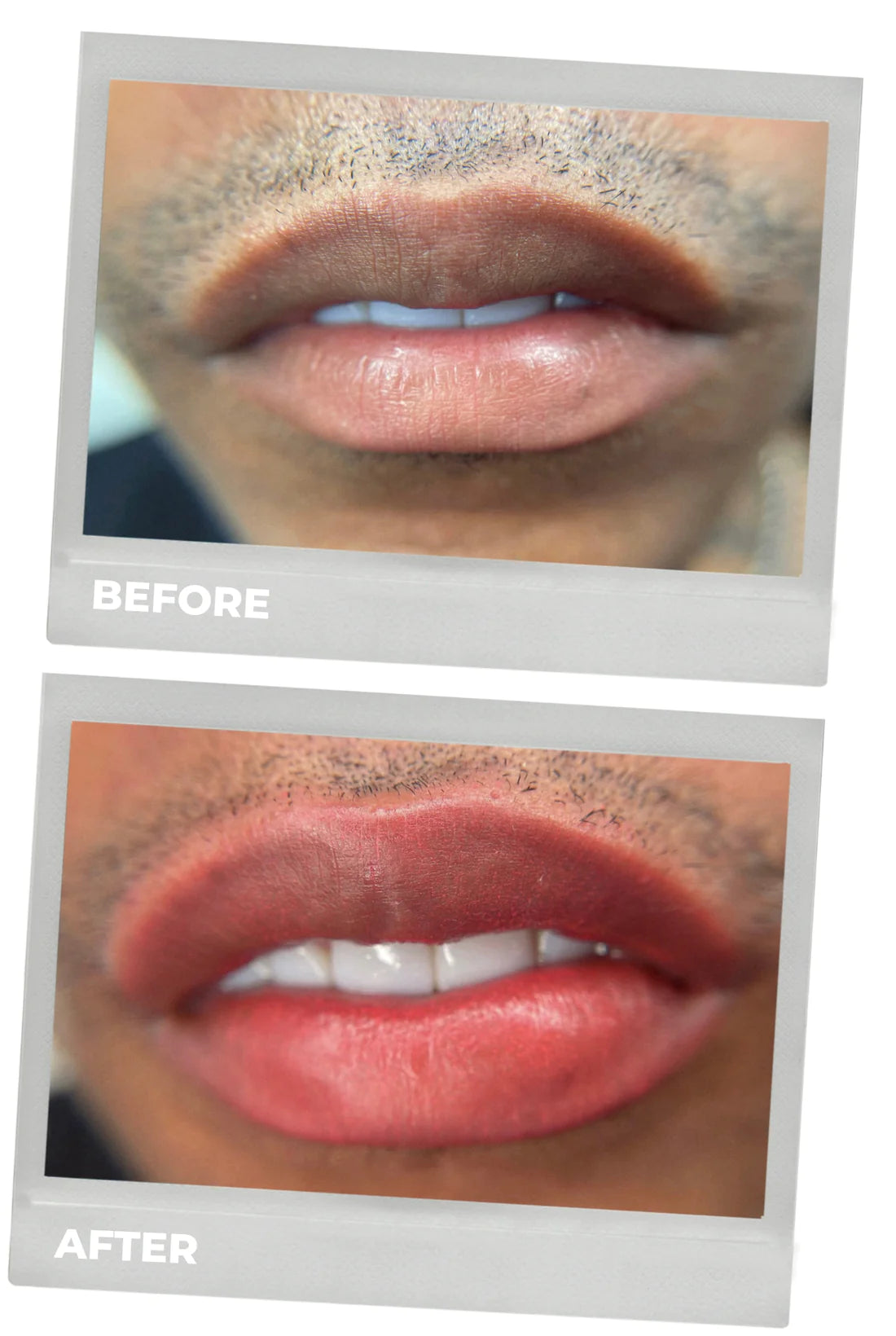 lip neutralization