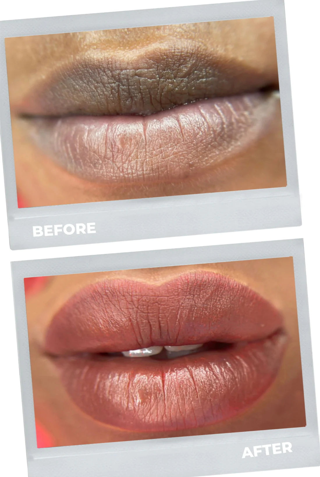 lip neutralization