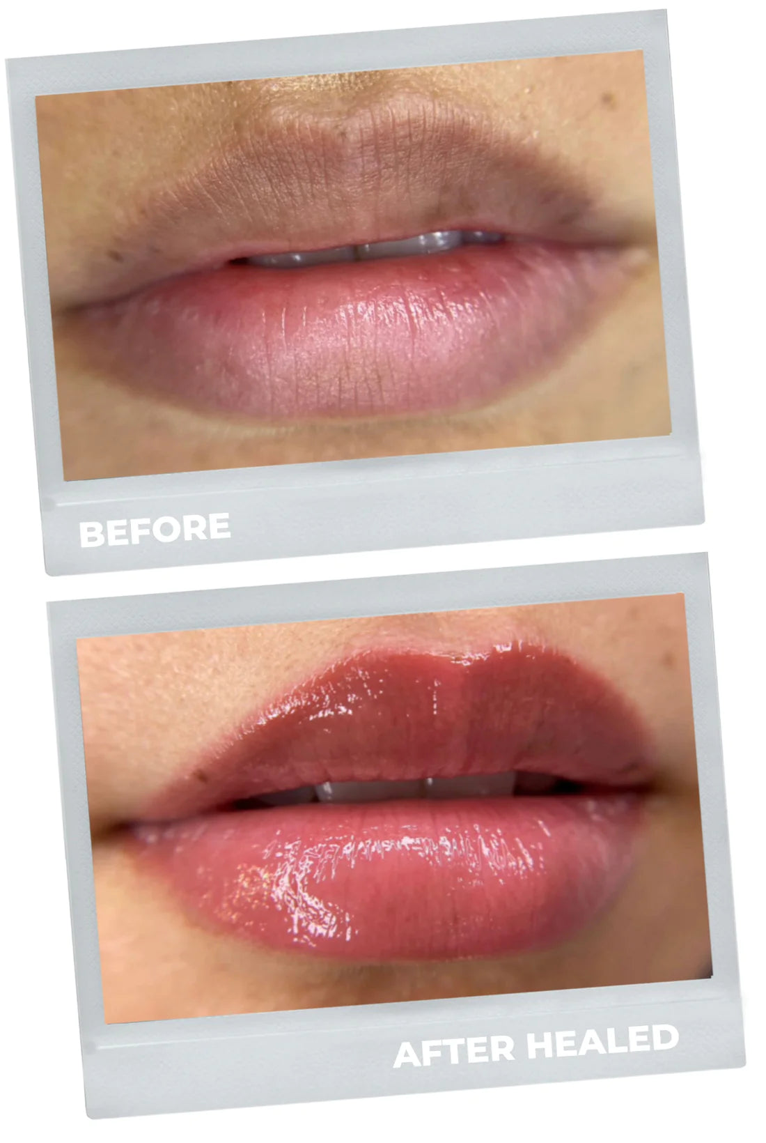 lip neutralization