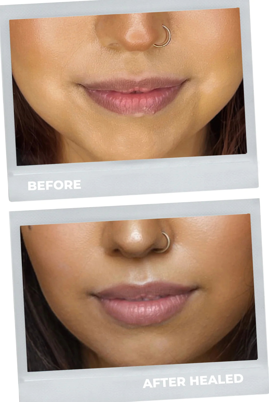 lip neutralization healed results